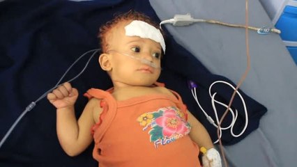 Unıcef'ten Yemen'de Yetersiz Beslenme Sorunu Yaşayan Çocuklara Yardım