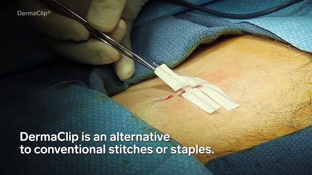 Needle-Less Alternative To Stitches