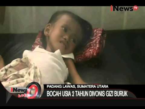 Miris 70 Tahun Merdeka Masih Ada Bocah 2 Tahun Kekurangan Gizi Di Sumatra Utara - iNews Pagi 25/08