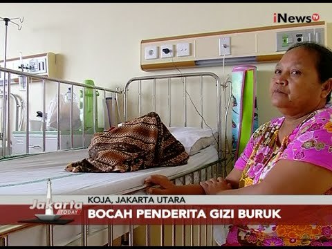 Di Kota Metropolitan Jakarta Masih Ada Saja Balita Yang Menderita Gizi Buruk - Jakarta Today 10/11