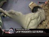 Miris Masih Ada Anak Dengan Gizi Buruk Di Musi Banyuasin Dan Banten - iNews Siang 24/11