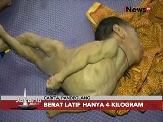 Kisah Balita Gizi Buruk Jakarta - Jakarta Today 24/11