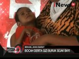 Potret kesehatan warga miskin, inilah bocah penderita gizi buruk sejak bayi - iNews Siang 30/03