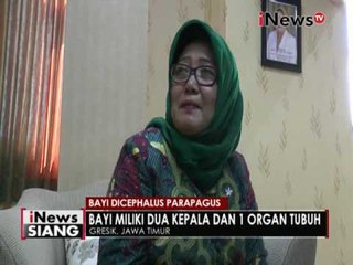 Bayi Dicephalus Parapagus di Gresik belum bisa di operasi - iNews Siang 19/08