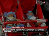 Pasca operasi pemisahan, bayi kembar siam asal Bengkulu sudah boleh pulang - iNews Siang 19/08