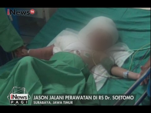 Balita yang Alami Luka Bakar Akibat Tercebur Diminyak Panas Sudah Mulai Membaik - iNews Pagi 03/02