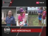 [Miris] Ibu yang Memiliki Bayi Hidrosefalus Hanya Menunggu Bantuan Pemerintah - iNews Siang 18/07