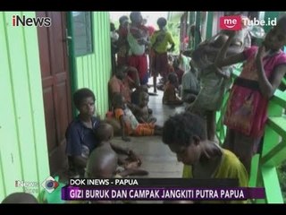 Ratusan Anak Terkena Campak dan Menderita Gizi Buruk di Bumi Cendrawasih - iNews Sore 27/01