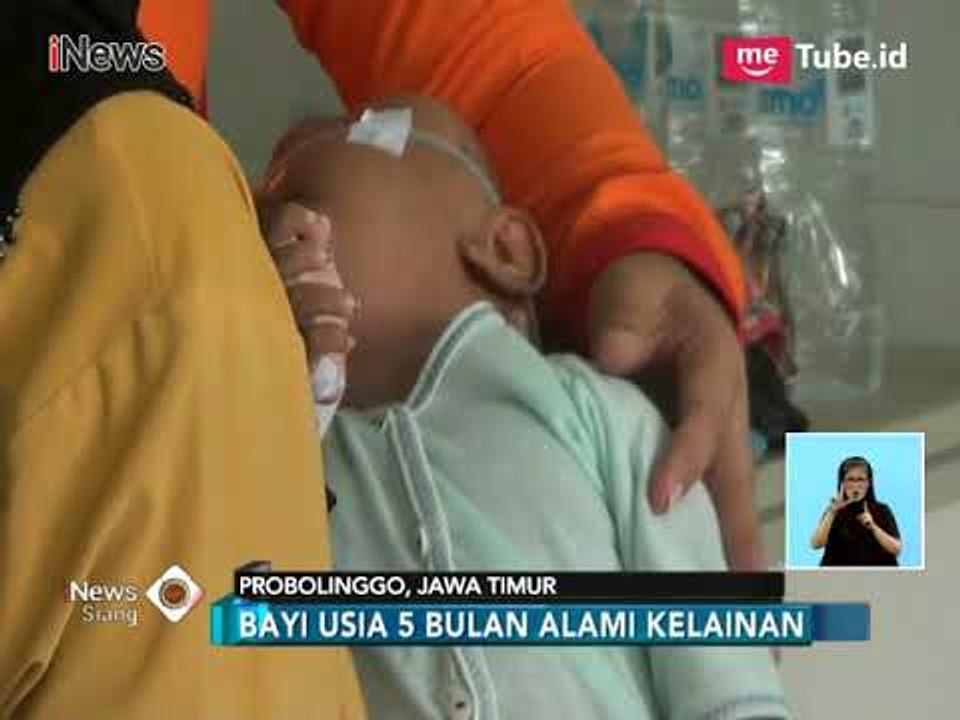 Kisah Haru Fatimah, Bayi Penderita Hidrosefalus di RSUD Waluyo - iNews Siang 15/03