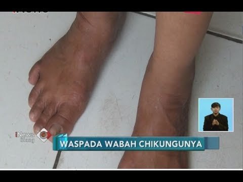 Waspada!! Puluhan Warga Depok Terserang Kelumpuhan Mendadak, Ini Penyebabnya - iNews Siang 30/06