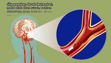 CHECK UP STROKE 1 DEFINISI, MITOS FAKTA STROKE