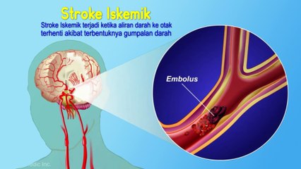 CHECK UP STROKE 2, penyebab dan jenis stroke