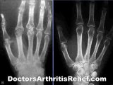 Arthritis Xray & Doctors Pain Relief