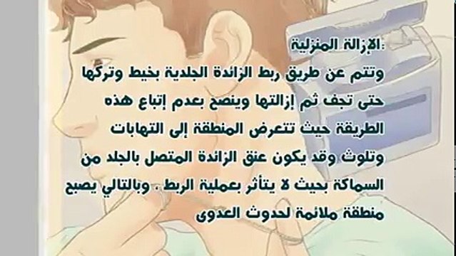 لكل شخص يعاني من هذه الزوائد لن تصدق كيف تتخلص منها بسهولة وفي يوم واحد تقريبا شاهد الطريقة السهلة دون الحاجة الى العمليات