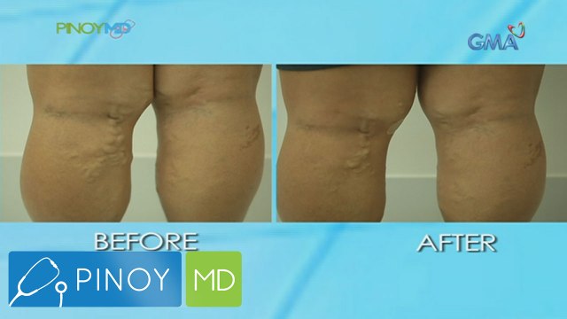 Pinoy MD: Solusyon sa varicose veins, alamin