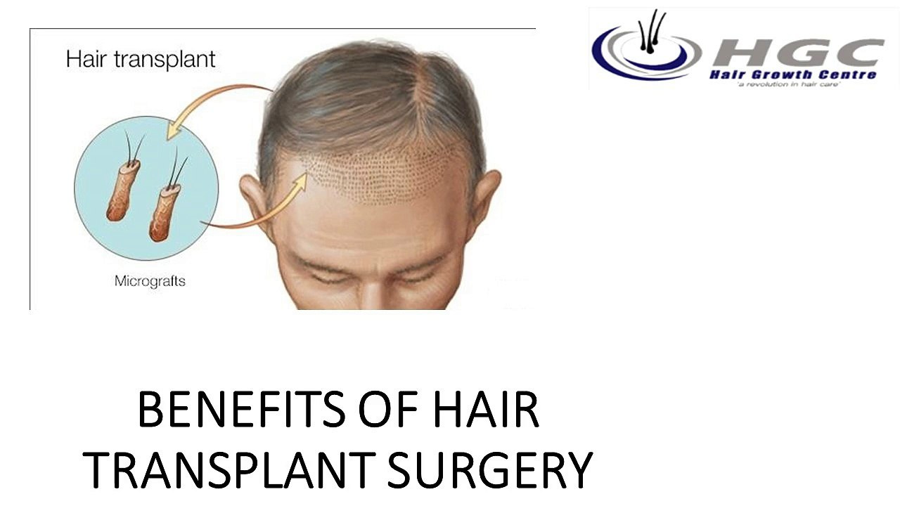 BENEFITS OF HAIR TRANSPLANT SURGERY