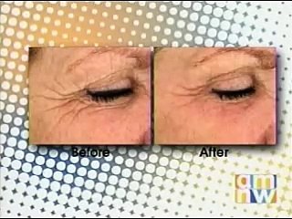 Pearl Fractional u0026 Pearl Lasers on News in Portland, OR