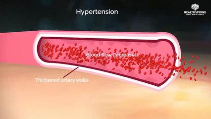 Hypertension - Health Spring