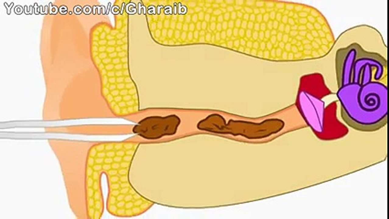 طريقة رائعة لستخراج الشمع والاوساخ من الأذن دون مخاطرة