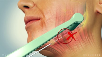 bodySCULPT Introduces EmbraceRF - a Breakthrough Treatment in Facial and Neck Rejuvenation