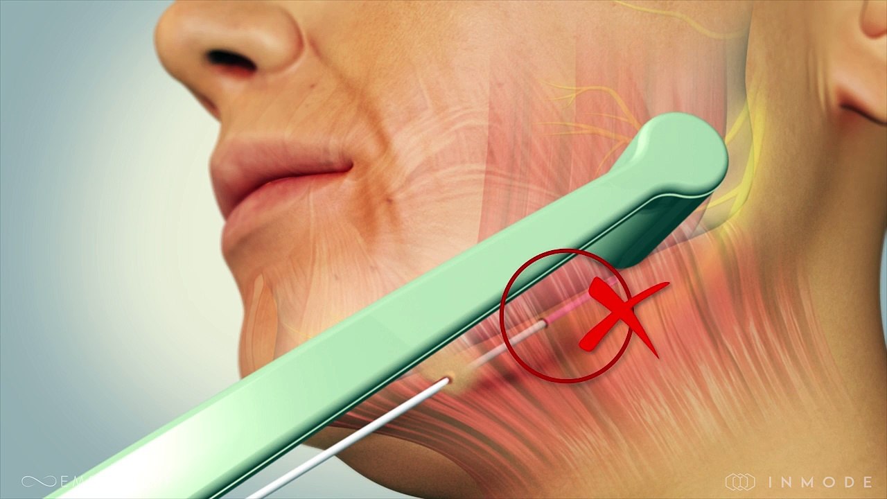 bodySCULPT Introduces EmbraceRF - a Breakthrough Treatment in Facial and Neck Rejuvenation