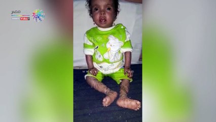 حكاية طفلة صعيدية أسمها كارما  تعانى من الآلام