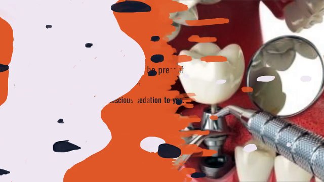 Dental Implants - Frequently Ask Questions - New Teeth in One Day Clinics