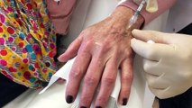 Verouderde handen behandelen met fillers | Praktijk voor Injectables