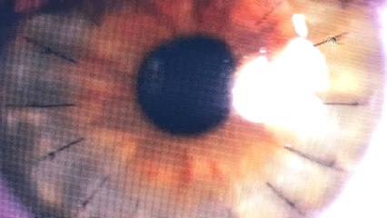 Genç kızın karanlık dünyası kornea nakli ile aydınlandı - ERZURUM