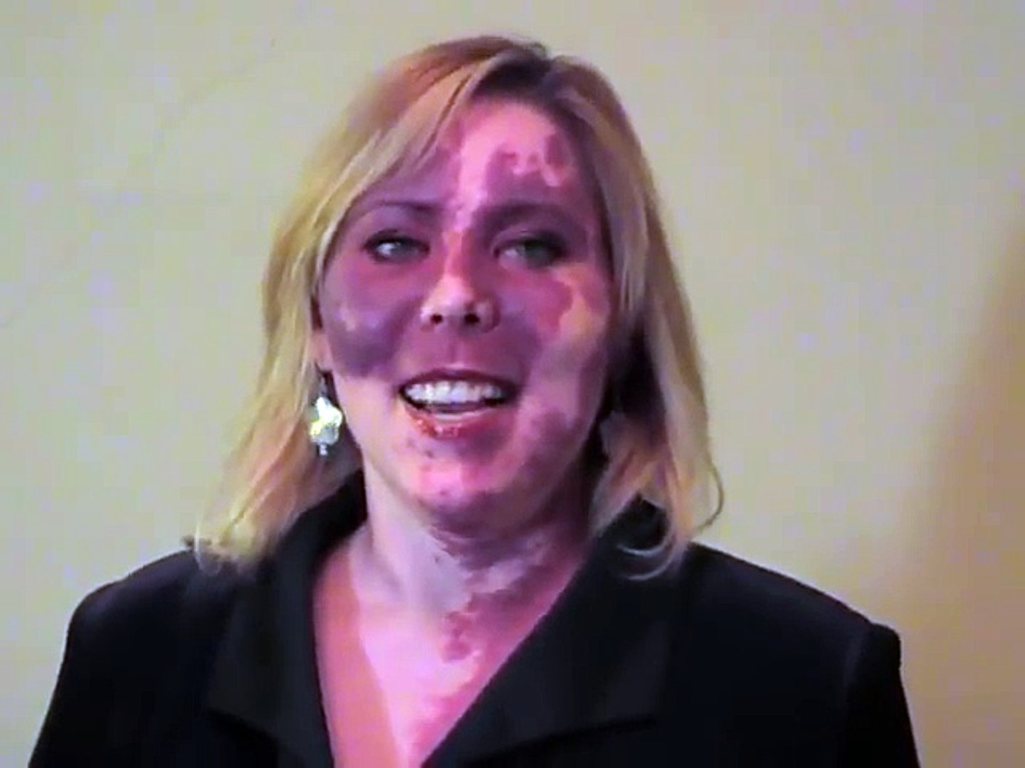 Cette Femme A L Enorme Angiome Sur Le Visage S Accepte Enfin Comme Elle Est Video Dailymotion