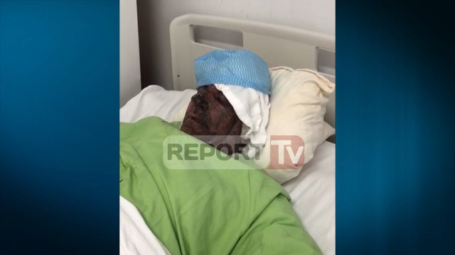 Report Tv - Vlorë, digjen rëndë dy punonjës të OSHEE-së