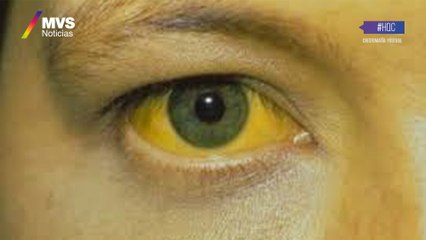 Virus mortales- fiebre amarilla