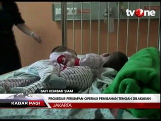 Dokter Siapkan Operasi Pemisahan Bayi Kembar Maxen dan Maxon