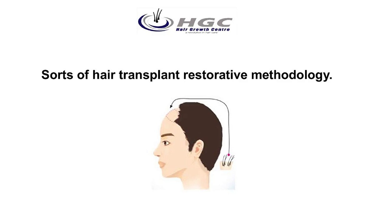 Sorts_of_hair_transplant_restorative_methodology_