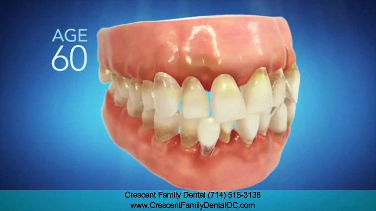 Invisalign Anaheim CA