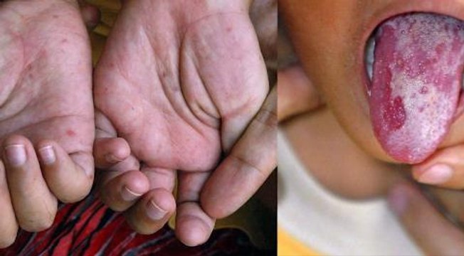 Health Minister: Action plan to combat HFMD is under way