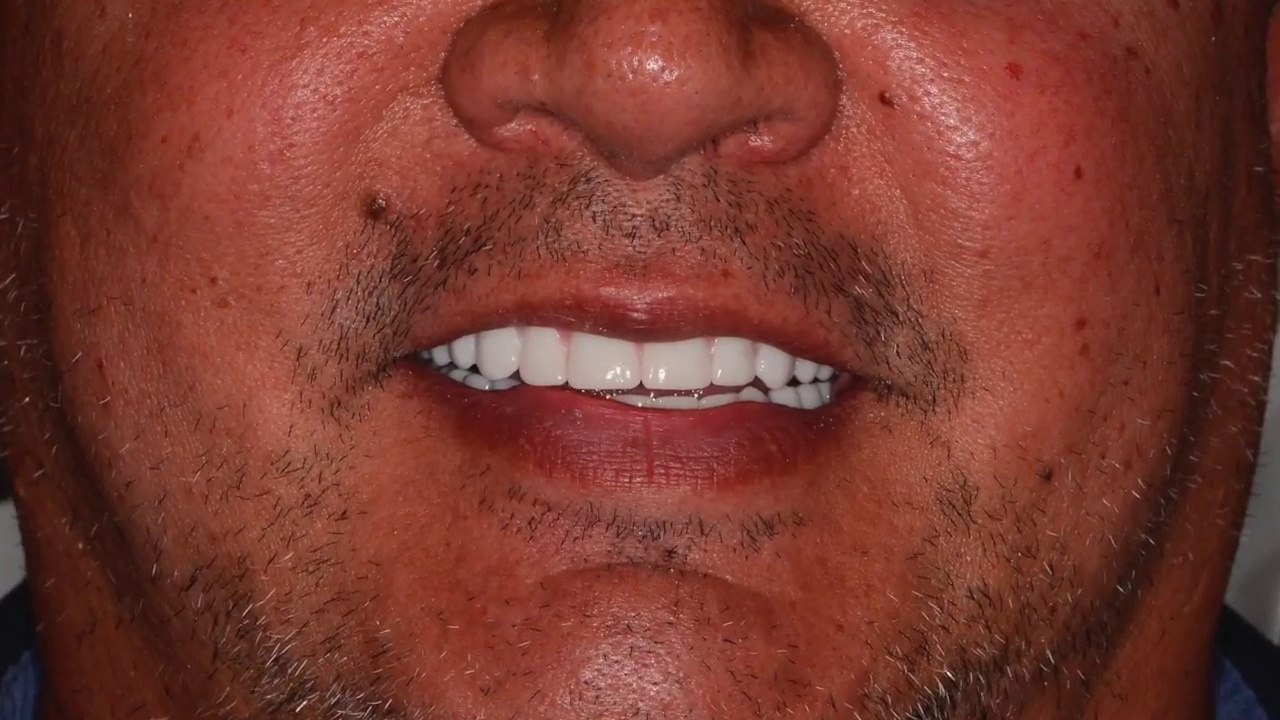 Same Day Dentures