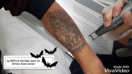 Dövme Silme İşlemi