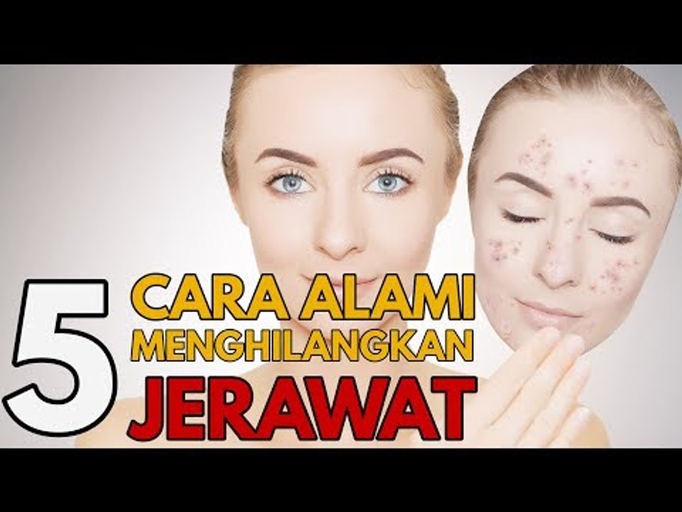 Bawang Putih Hingga Alpukat, Menghilangkan Jerawat dengan Cara Alami