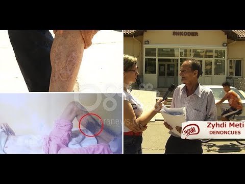 Skandal në Spitalin e Shkodrës, pacienti shkon për të operuar stomakun, del i djegur