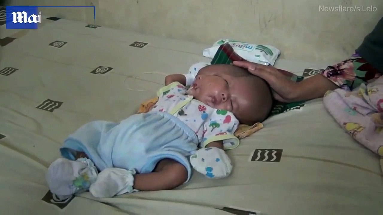 Em bé hai mặt chào đời ở Indonesia