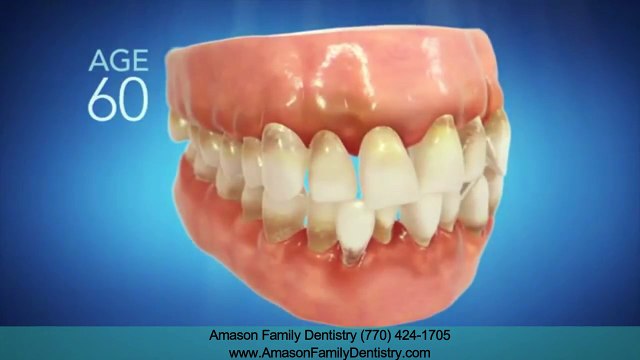 Invisalign Kennesaw GA