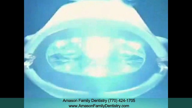 Zoom Whitening Kennesaw GA