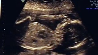 19 week ultrasound! Its a girl! Includes 3d/4d scan!