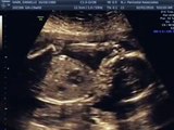 19 week ultrasound! Its a girl! Includes 3d/4d scan!