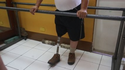 Los retos de vivir con una prótesis en Guatemala