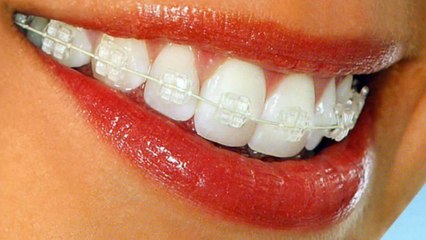 Aparelho Fixo com Braquetes de Safira o que sao