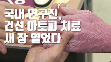 [자막뉴스] 국내 연구진, 건선·아토피 치료 새 장 열었다 / YTN