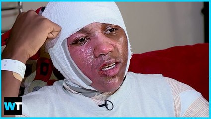 ANOTHER TEEN Severely Burned During HOT WATER CHALLENGE!!