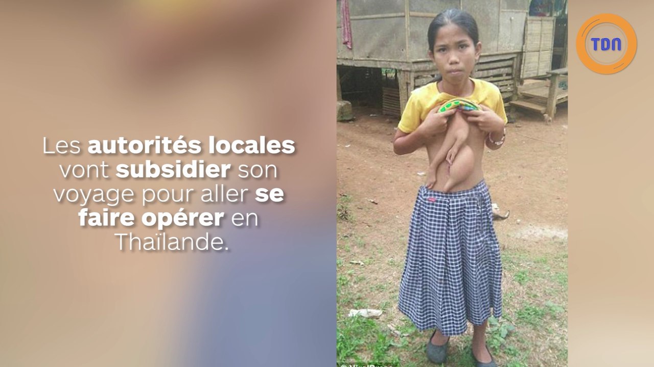 Elle vit avec les bras de sa sœur jumelle parasite dans le ventre et doit même lui couper les ongles !